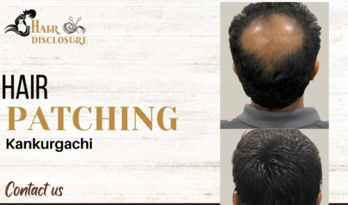 Hair Patching For Personal