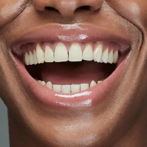 Teeth Cleaning and Polishing