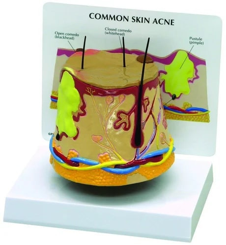 PP Acne Skin Model For Medical College