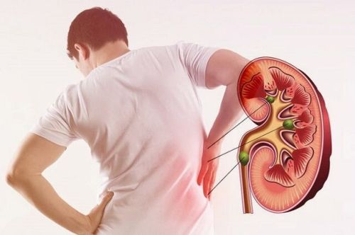 Kidney Stone Removal Treatment Service