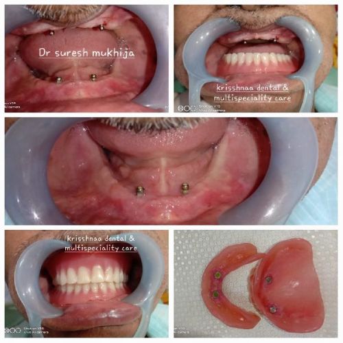 Implant Supported Denture