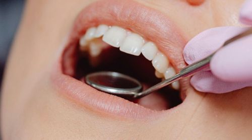 Wisdom Tooth Extraction