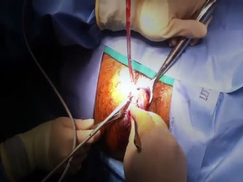 Laser Piles Surgery