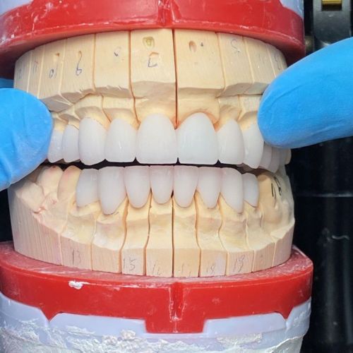 Zirconia Dental Crown, Packaging Type : Box, Carton for Hospital