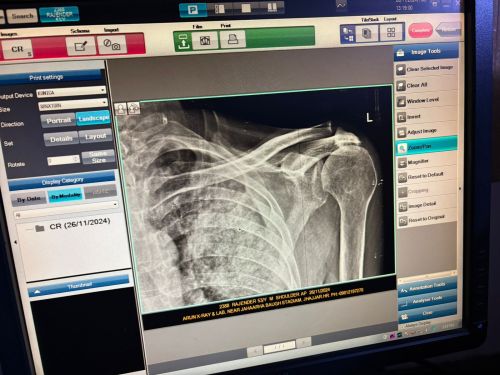 Electric Digital X Ray Machine for Radiography