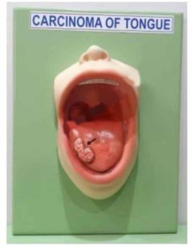 Plastic Carcinoma Tongue Pathology Model