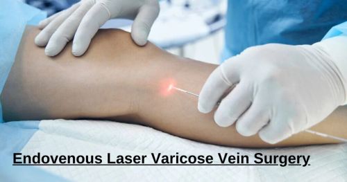 Varicose Veins Laser Equipment