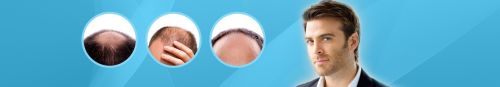 Hair Transplant Services