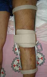 Push Knee Splint, Feature : Rust Proof