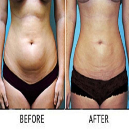 Liposuction Surgery