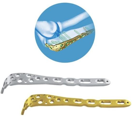 Locking Olecranon Plate