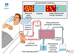 Auxin+ Dialysis Solutions