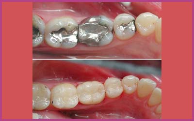 Cavity Filling Materials