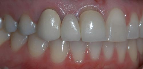 Dental Crowns and Bridges