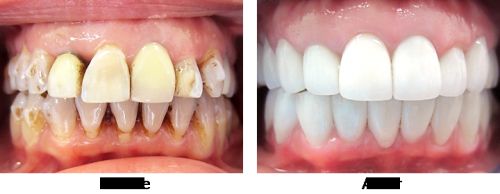 Full Mouth Rehabilitation