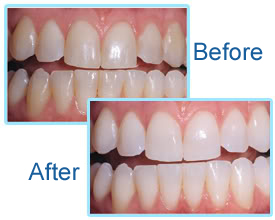 Teeth Whitening Services