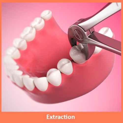 Dental Extraction Services