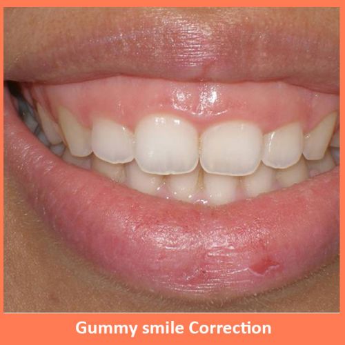 Gummy Smile Correction