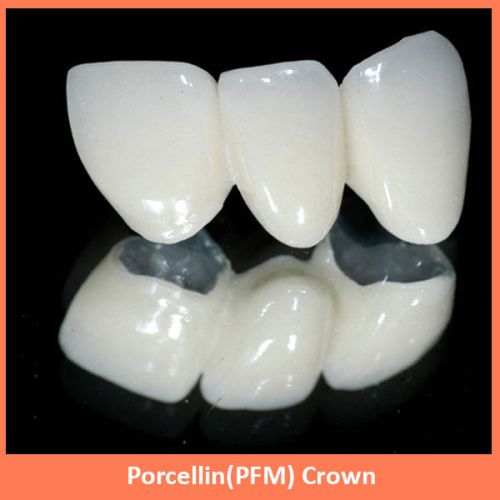 Porcellin (PFM) Crown