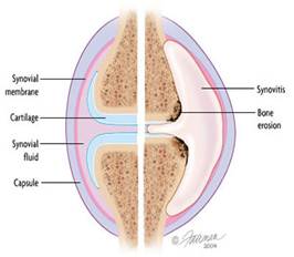 Osteoarthritis Medicine