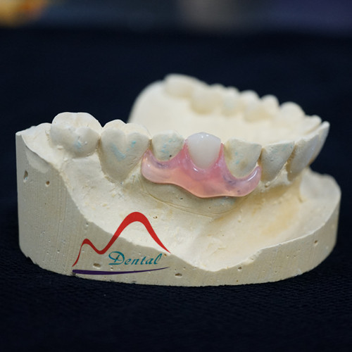Comfortable Valplast Flexible Denture