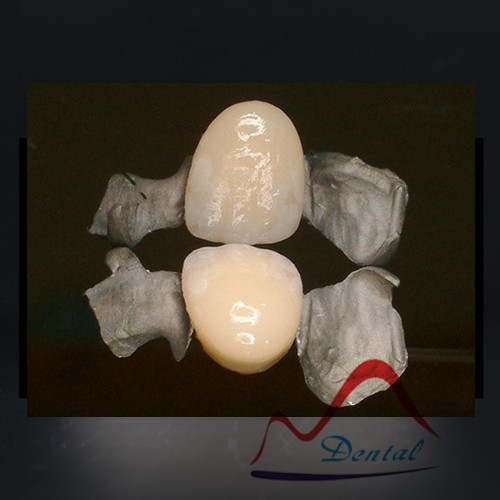 Dental Aesthetic Maryland PFM Bridge