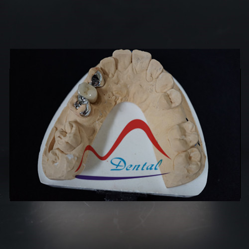 Individually Made Dental Maryland Bridge