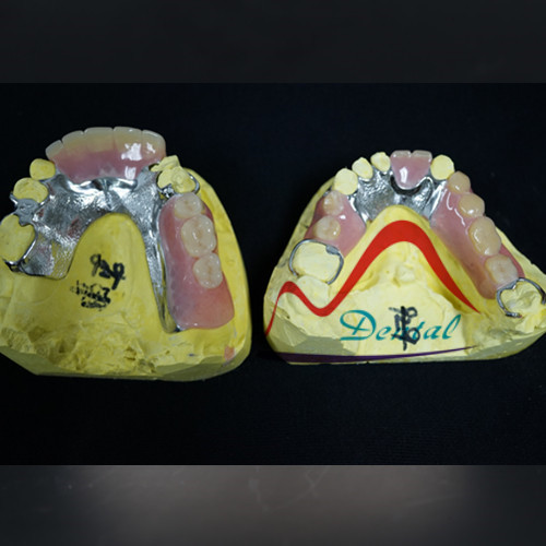 Refinned Partial Framework Removable Denture