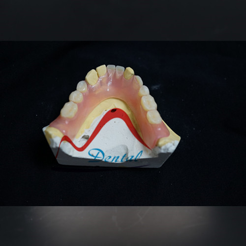 TCS Removable Partial Denture