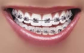 Dental Bracket