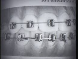 Begg Brackets