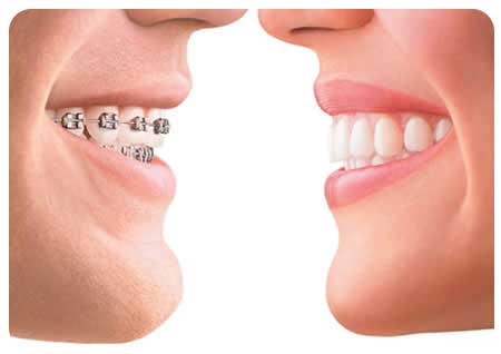 Dental Brace