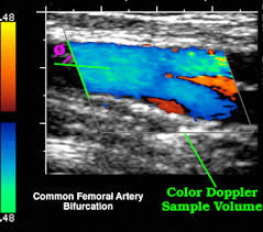 Color Doppler