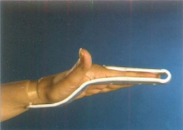 Finger Extension Splint