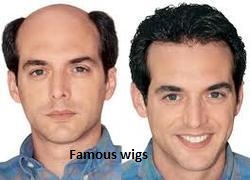 Hair Replacement System