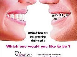 Clear Path Aligners Invisible Braces