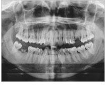 Digital Panoramic X-Ray