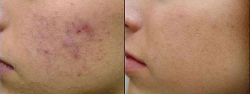 FLAT SCARS TREATMENT