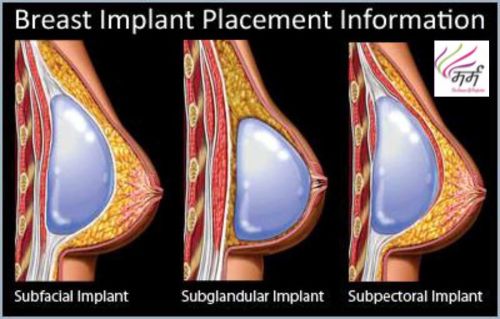 Breast Implant Surgery