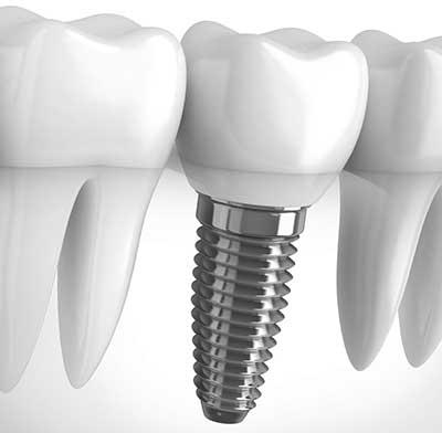 Dental Implants Service