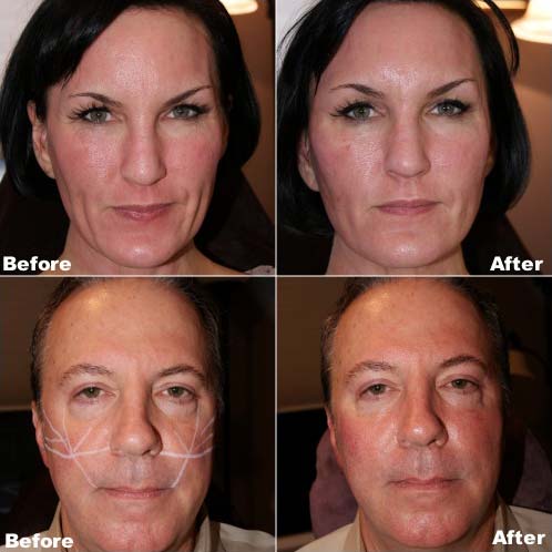 Hyadermis Facial Dermal Hyaluronic Acid Gel