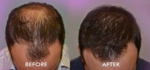 Hair Transplant Service